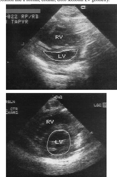 Figure 1 From Conditions With Right Ventricular Pressure And Volume