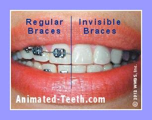 Learn what factors besides insurance insurance rarely covers the entire cost of braces. Cheap braces without insurance - insurance