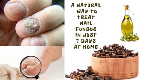 A Natural Way To Treat Nail Fungus In Just 7 Days At Home Treatment