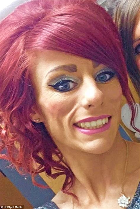 Woman Hits Back At Trolls Who Branded Her Anorexic Over Sunken Face Daily Mail Online