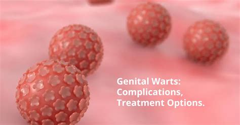 Genital Warts Complications And Treatment Options Metromale Clinic And Fertility Center