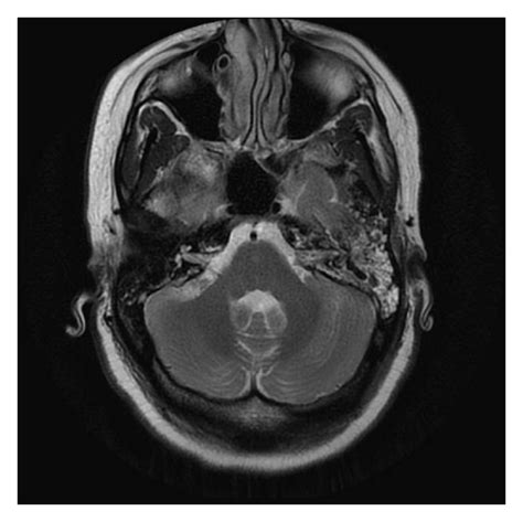 Mri Of Brain With Contrast Demonstrating Fluid And Enhancement Within