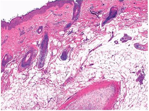 Squamous Cell Carcinoma Histology Ear