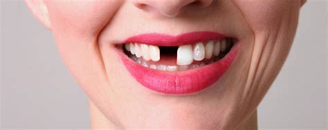 Do Brits Really Have Bad Teeth Bbc Future