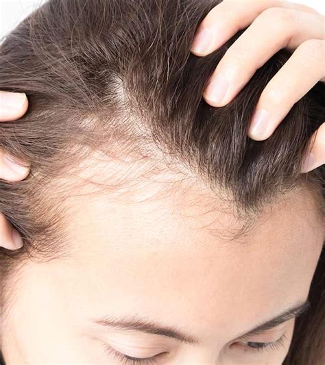 Лечение от выпадения волос способы препараты домашние рецепты советы трихолога