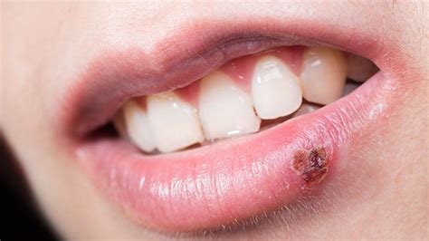 Cold Sore Stages Pictures Know How To Get Rid Of Cold Sore