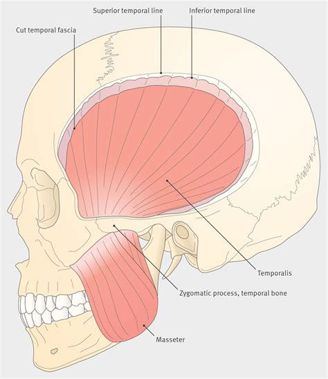 Surface Anatomy Of Temporalis And Masseter Muscles Adapted From