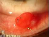 Conjunctival Pyogenic Granuloma Treatment Pictures