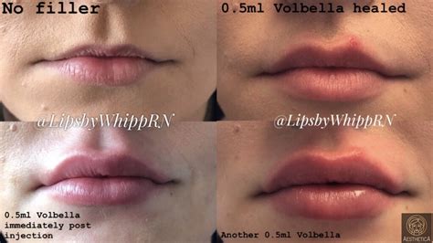 Lip Filler Before And After Photos Swansea Ma