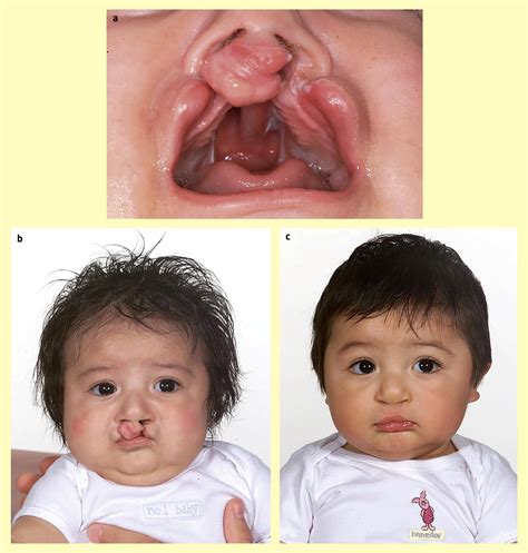 References In Cleft Lip And Palate Current Management Paediatrics