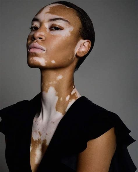 Vitiligo Causes Treatment And Cures For The Rare Skin Condition