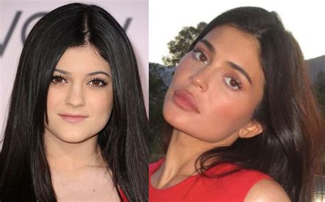 Kylie Jenner Antes Y Despu S De Sus Cirug As Est Ticas Fotos Chic