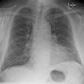 Eine herzmuskelentzündung (myokarditis) ist eine entzündliche erkrankung des herzmuskels. Category:X-rays of the chest - Wikimedia Commons