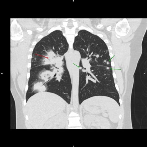 Figure 1 From A Rare Case Of Cavitary Lung Lesions In An Adolescent
