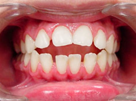 Shine Orthodontics Open Bite