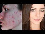 Pictures of Covering Acne Scars With Makeup