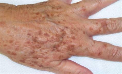 Cause And Treating Dark Spots On Hands Arms Or Legs Skincarederm