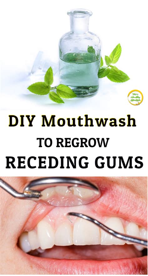Diy Mouthwash For Receding Gums Oralhealth For Receding Gums There