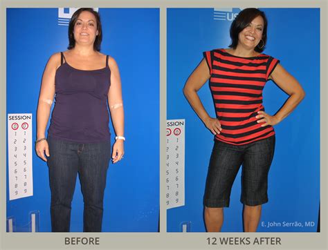 Weight Loss And Wellness Center Before And After Pictures Orlando Fl
