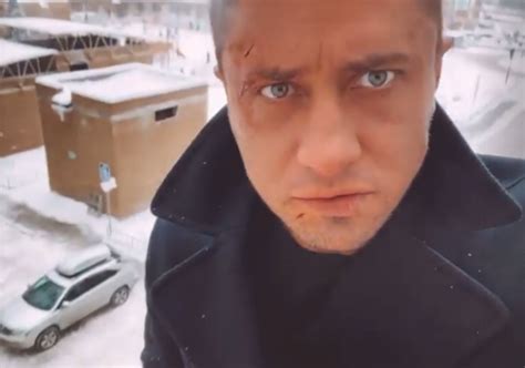 Шрамы на лице Павла Прилучного напугали поклонников в Instagram ФОТО