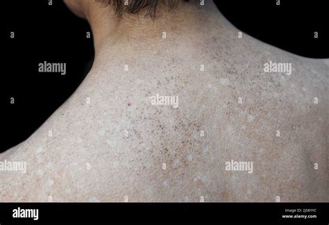 Age Spots And White Patches On Upper Back Of Asian Elder Man Age Spots