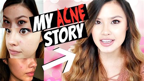 My Acne Story Effective Spot Treatment For Pimples And Breakouts The
