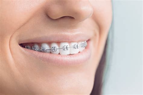Types Of Braces Right For You Dr Floreani Otoole And Dool Orthodontics