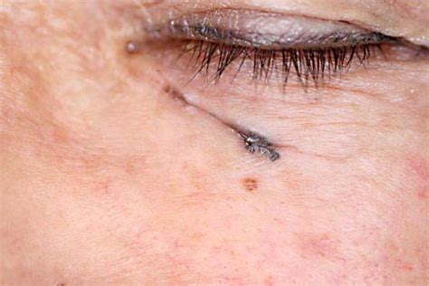 Linear Basal Cell Carcinoma A Case Report Abstract Europe Pmc