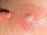 Underarm Cyst Causes, Pictures, Painful, Sebaceous ...