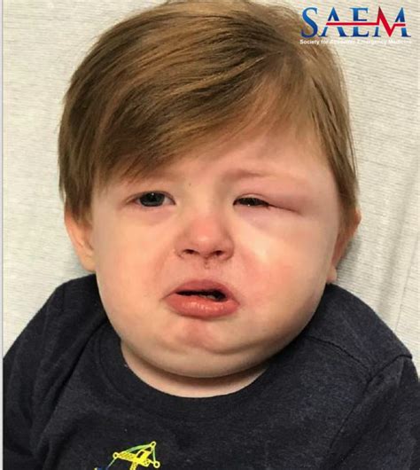 Saem Clinical Image Series Facial Swelling In A 2 Year Old Med Tac International Corp