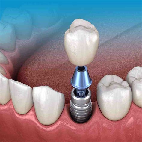 How Long For Mini Dental Implant Pain To Stop Dental News Network