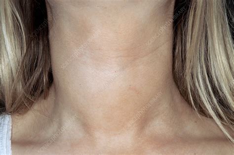 Goitre In Hashimotos Thyroiditis Stock Image C0117383 Science