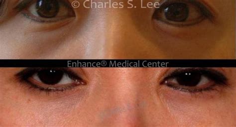 Lower Eyelid Surgery Charles S Lee Md