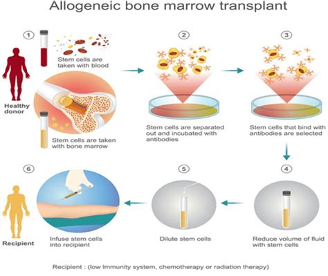 Allogeneic Hematopoietic Stem Cell Transplant 17 Download Scientific Diagram