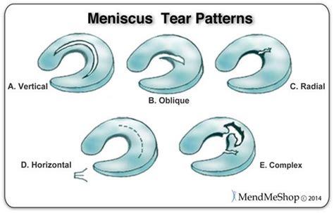 5 Types Of Meniscal Tear Patterns Laterial And Medial Meniscus Knee