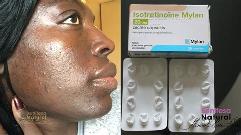 Isotretinoin Roaccutane Journey 20mg Month 4 Results Dark Skin