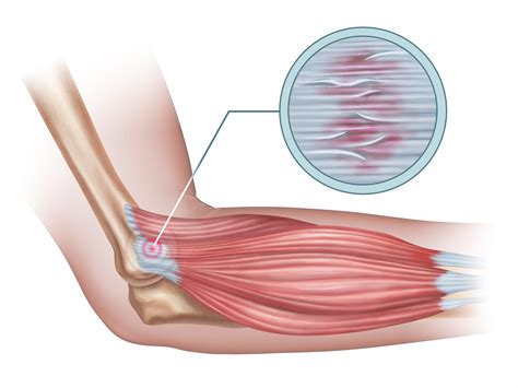 Tendinitis Vs Tendinosis What S The Difference And Steps To Recovery