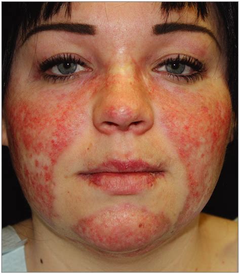 Photosensitivity In Cutaneous Lupus Dermatology Nurse Dermatology Lupus