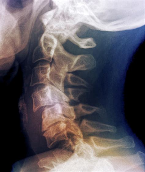 Dislocated Neck Bones Photograph By Zephyrscience Photo Library