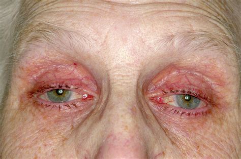 Eye Drop Allergy Photograph By Science Photo Library