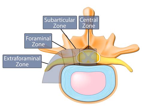 Foraminal Disc Protrusion Treatment Captions Beautiful