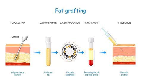 Your Guide To Fat Grafting Spiro Plastic Surgery
