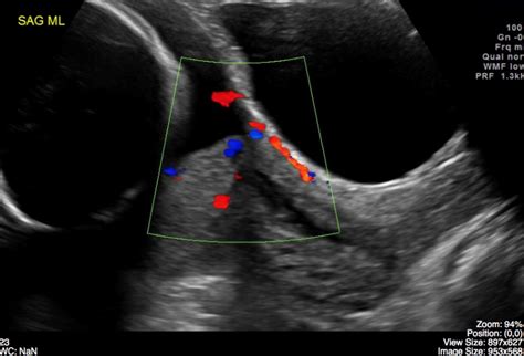 Placenta Previa Undergraduate Diagnostic Imaging Fundamentals