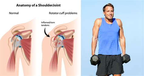 How To Shrug Off Shoulder Pain Nafc Fitness Certification