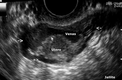 Varices Pelvicas