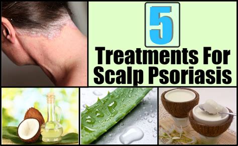 Top 5 Treatments For Scalp Psoriasis Mzizi Mkavu