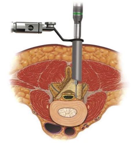 Minimally Invasive Surgery Lumbar Spine Rocky Mountain Brain And Spine Institute