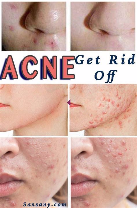 What Is Pitted Acne Scars Beckybeatle