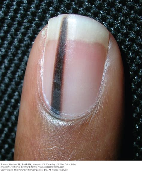Linear Pigmentation Nails Best Nail Designs 2020