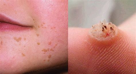 Cheapest Way To Effectively Remove Warts Everyone Needs To Know
